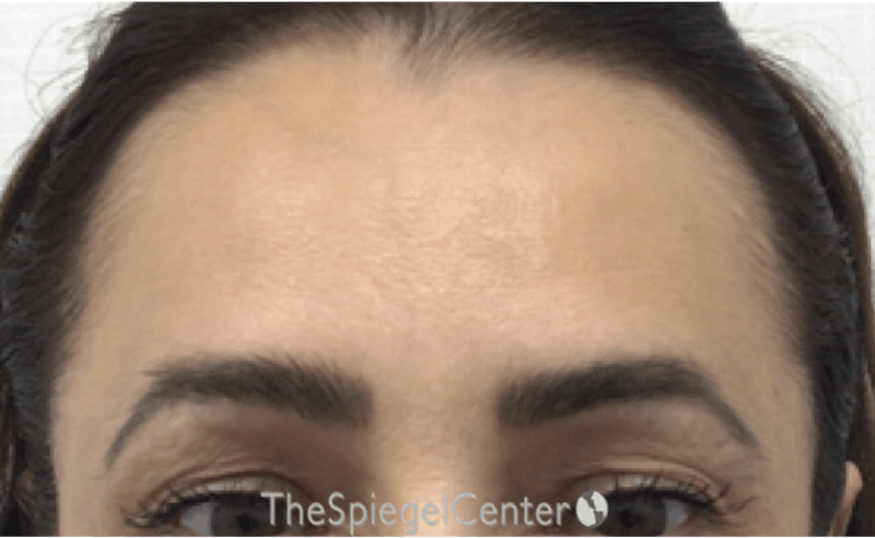 Browlift / Fox Eye Lift Before & After Gallery - Patient 125908 - Image 1