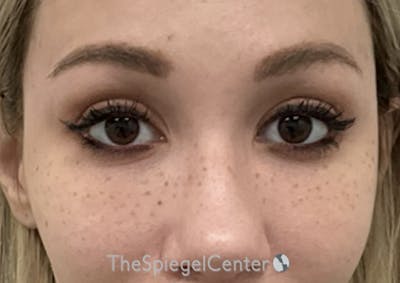 Temple Filler Before & After Gallery - Patient 518193 - Image 2