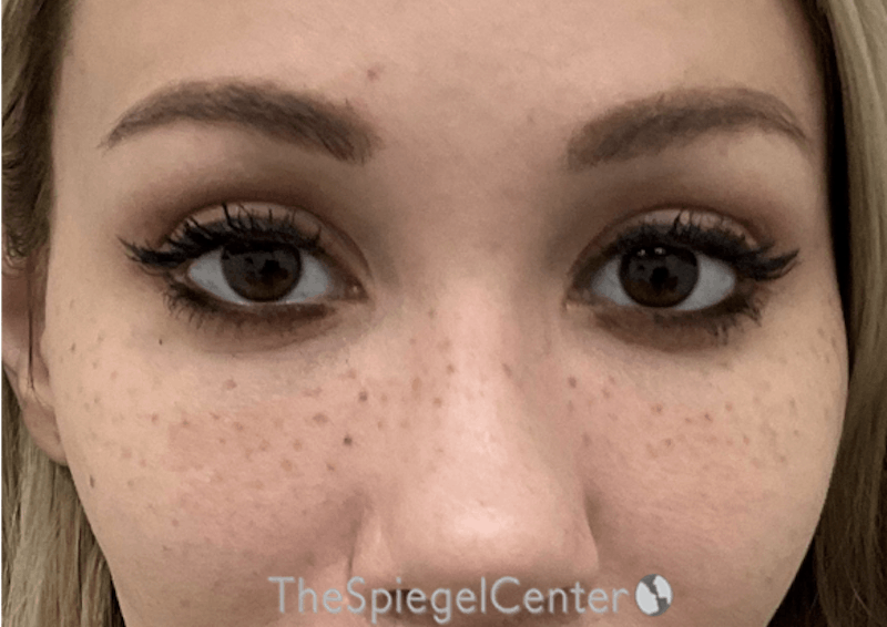 Temple Filler Before & After Gallery - Patient 518193 - Image 1