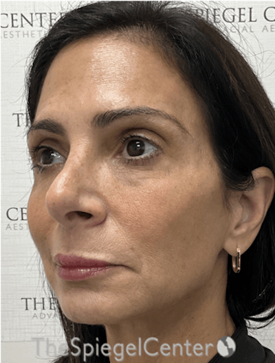 Facelift Before & After Gallery - Patient 108147 - Image 3