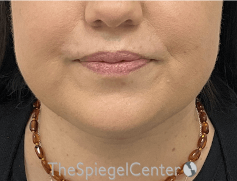 Facetite / Necktite / Embrace / Accutite Before & After Gallery - Patient 327368 - Image 2