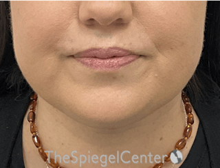 Facetite / Necktite / Embrace / Accutite Before & After Gallery - Patient 327368 - Image 2
