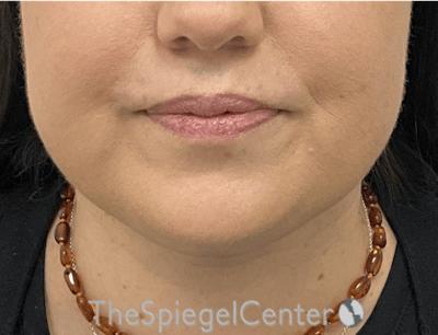 Facetite / Necktite / Embrace / Accutite Before & After Gallery - Patient 327368 - Image 2