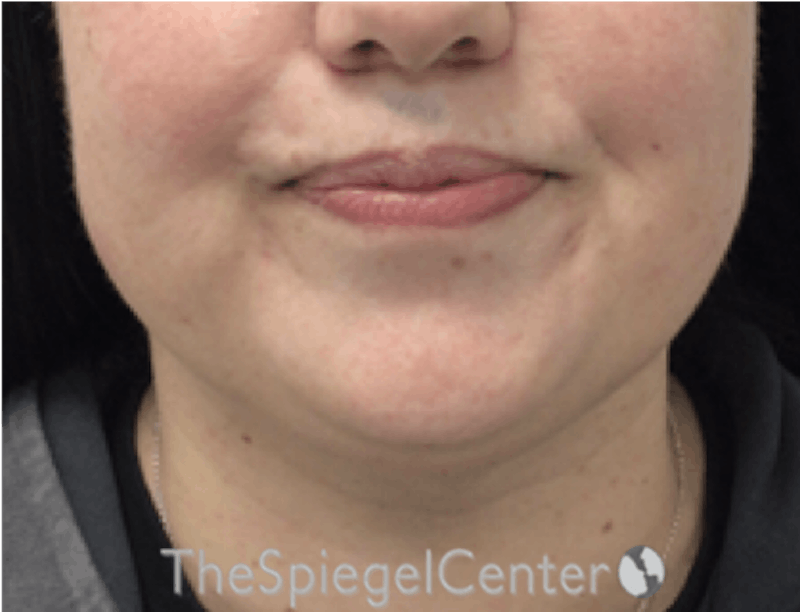 Facetite / Necktite / Embrace / Accutite Before & After Gallery - Patient 327368 - Image 1