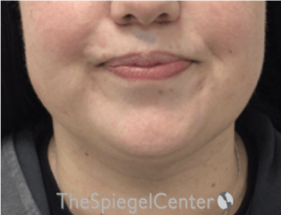 Facetite / Necktite / Embrace / Accutite Before & After Gallery - Patient 327368 - Image 1