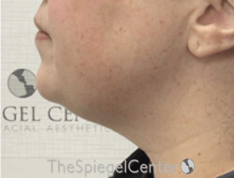 Facetite / Necktite / Embrace / Accutite Before & After Gallery - Patient 327368 - Image 3