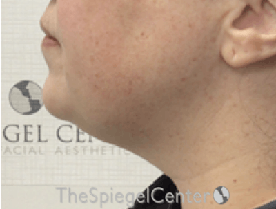 Facetite / Necktite / Embrace / Accutite Before & After Gallery - Patient 327368 - Image 3