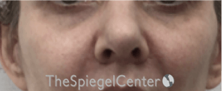 Cheek Implants Before & After Gallery - Patient 105178 - Image 2