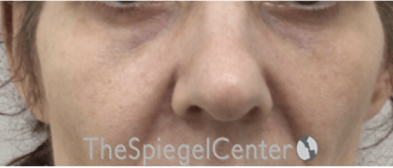 Cheek Implants Before & After Gallery - Patient 105178 - Image 1