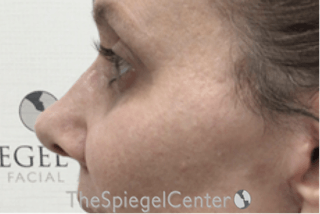 Cheek Implants Before & After Gallery - Patient 105178 - Image 4
