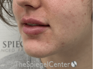 Lip Filler Before & After Gallery - Patient 143928 - Image 6