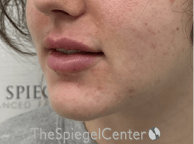 Lip Filler Before & After Gallery - Patient 143928 - Image 6