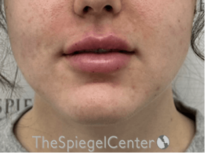 Lip Filler Before & After Gallery - Patient 143928 - Image 4