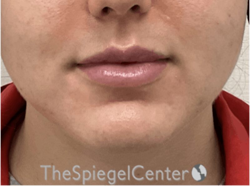 Lip Filler Before & After Gallery - Patient 143928 - Image 3