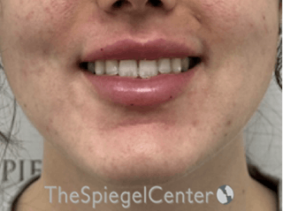 Lip Filler Before & After Gallery - Patient 143928 - Image 2