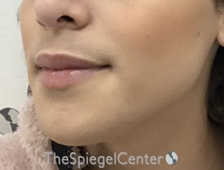 Mandible Contouring Before & After Gallery - Patient 157140049 - Image 4