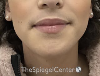 Mandible Contouring Before & After Gallery - Patient 157140049 - Image 2