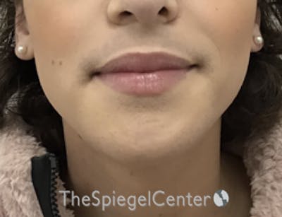 Mandible Contouring Before & After Gallery - Patient 157140049 - Image 2