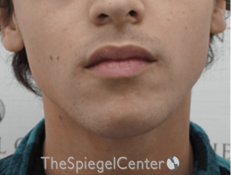 Mandible Contouring Before & After Gallery - Patient 157140049 - Image 1