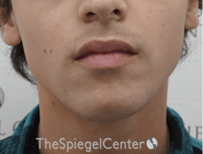 Mandible Contouring Before & After Gallery - Patient 157140049 - Image 1