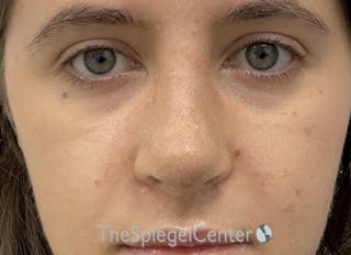 Rhinoplasty Before & After Gallery - Patient 358327 - Image 4