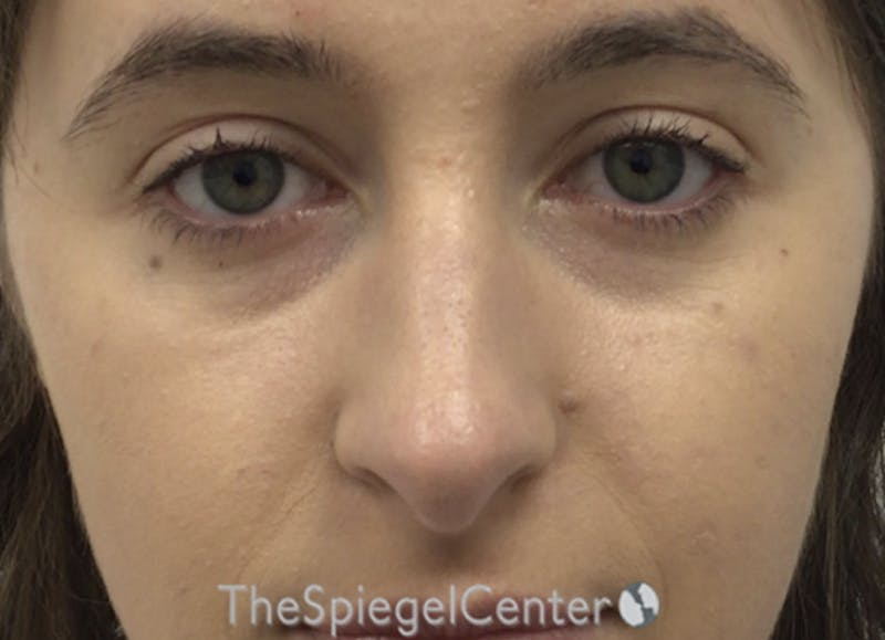 Rhinoplasty Before & After Gallery - Patient 358327 - Image 3