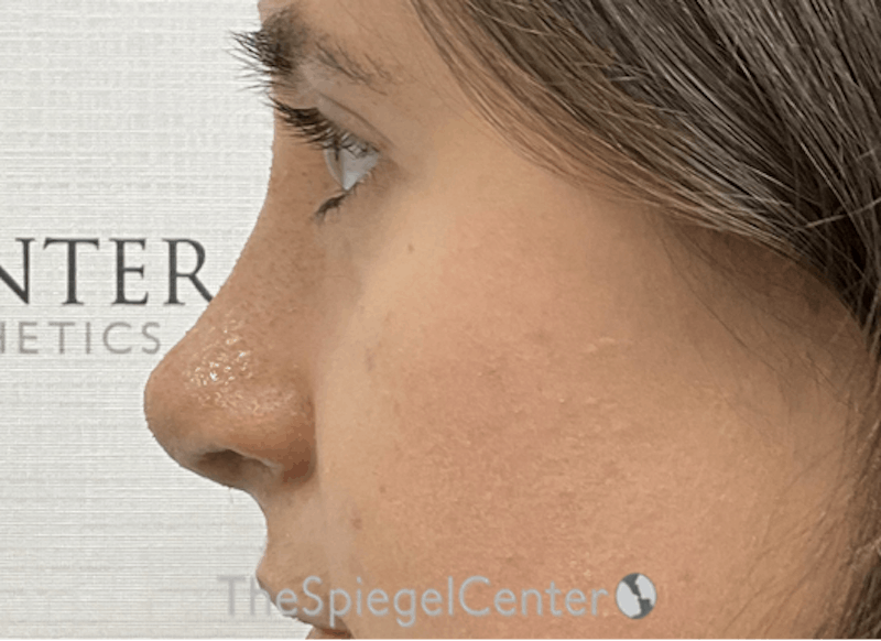 Rhinoplasty Before & After Gallery - Patient 358327 - Image 2