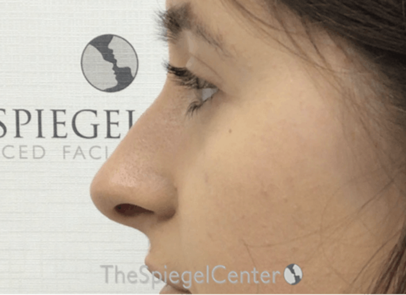 Rhinoplasty Before & After Gallery - Patient 358327 - Image 1