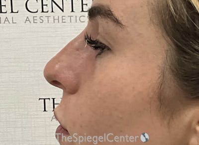 Non-Surgical Rhinoplasty / Nose Filler Before & After Gallery - Patient 139698 - Image 4