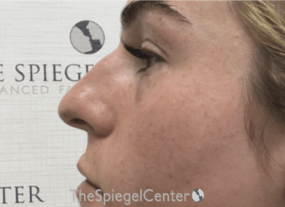 Non-Surgical Rhinoplasty / Nose Filler Before & After Gallery - Patient 139698 - Image 3