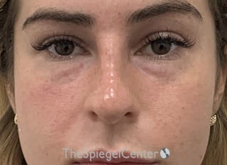 Non-Surgical Rhinoplasty / Nose Filler Before & After Gallery - Patient 139698 - Image 2