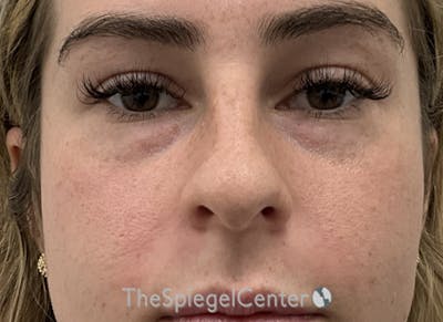 Non-Surgical Rhinoplasty / Nose Filler Before & After Gallery - Patient 139698 - Image 1