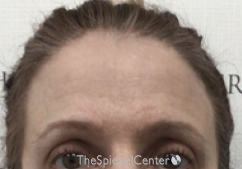 Browlift / Fox Eye Lift Before & After Gallery - Patient 232508 - Image 2