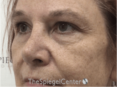 Blepharoplasty Before & After Gallery - Patient 404440 - Image 3