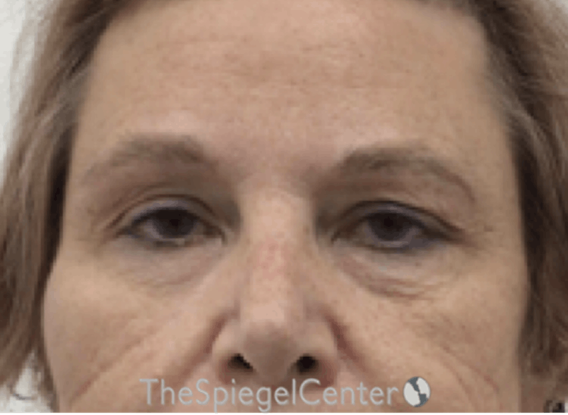 Blepharoplasty Before & After Gallery - Patient 404440 - Image 1