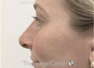 Non-Surgical Rhinoplasty / Nose Filler Before & After Gallery - Patient 226113 - Image 4
