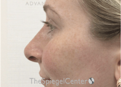 Non-Surgical Rhinoplasty / Nose Filler Before & After Gallery - Patient 226113 - Image 4