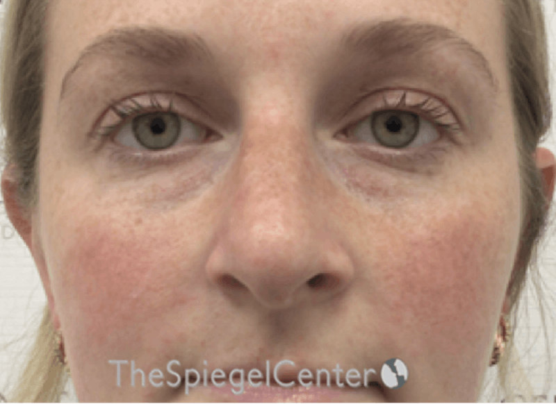 Non-Surgical Rhinoplasty / Nose Filler Before & After Gallery - Patient 226113 - Image 1