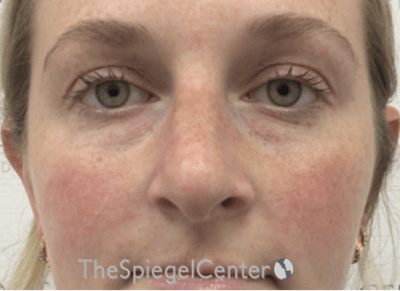 Non-Surgical Rhinoplasty / Nose Filler Before & After Gallery - Patient 226113 - Image 1