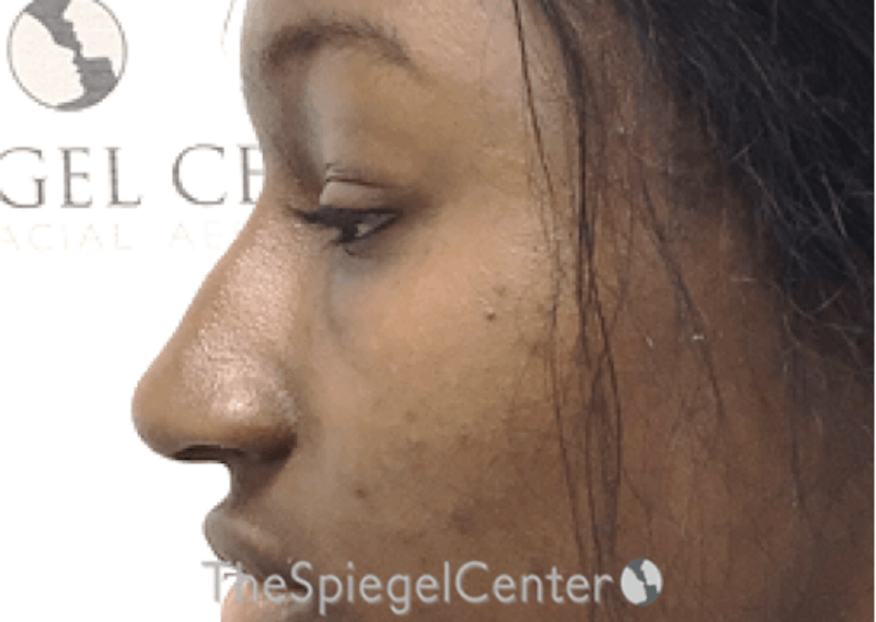 Non-Surgical Rhinoplasty / Nose Filler Before & After Gallery - Patient 852668 - Image 4