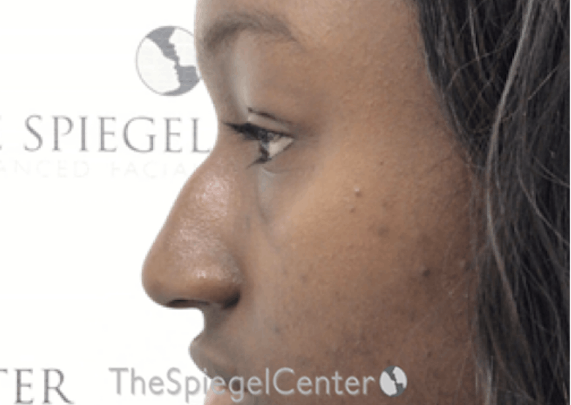 Non-Surgical Rhinoplasty / Nose Filler Before & After Gallery - Patient 852668 - Image 3