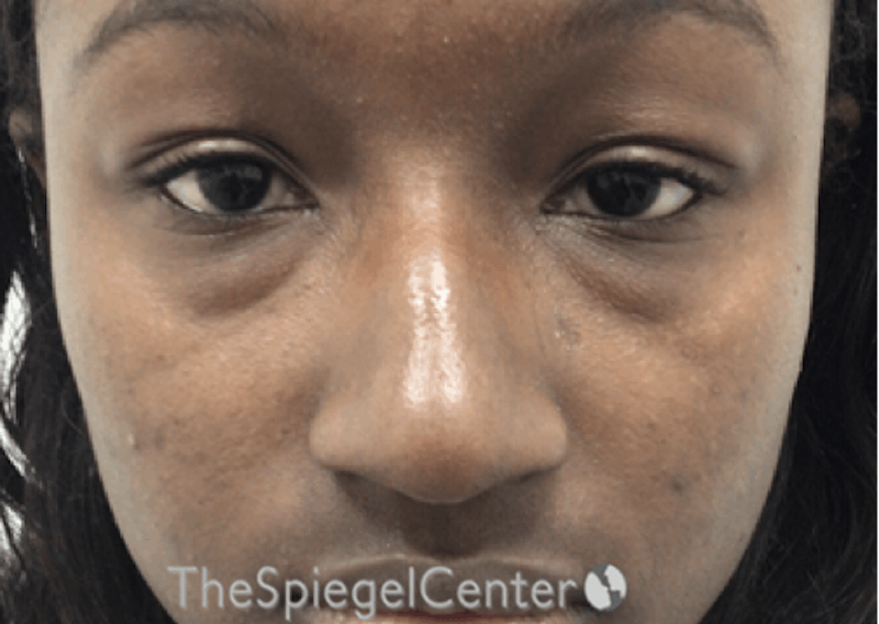 Non-Surgical Rhinoplasty / Nose Filler Before & After Gallery - Patient 852668 - Image 1