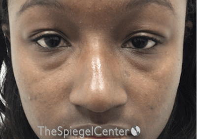 Non-Surgical Rhinoplasty / Nose Filler Before & After Gallery - Patient 852668 - Image 1