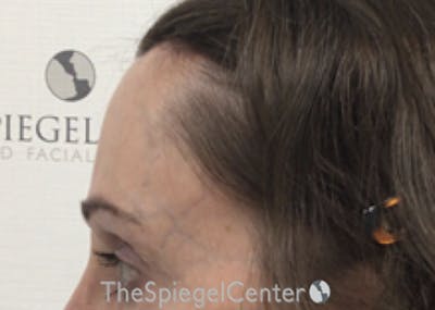 Forehead Contouring Before & After Gallery - Patient 399982 - Image 4