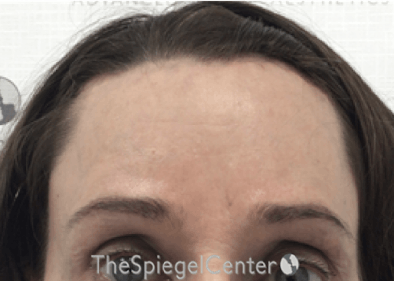Forehead Contouring Before & After Gallery - Patient 399982 - Image 2