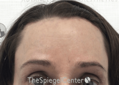 Forehead Contouring Before & After Gallery - Patient 399982 - Image 2
