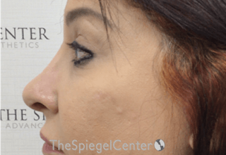 Rhinoplasty Before & After Gallery - Patient 347957 - Image 2