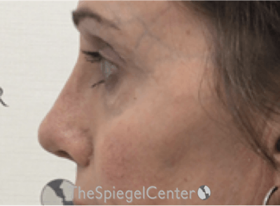 Rhinoplasty Before & After Gallery - Patient 379194 - Image 2