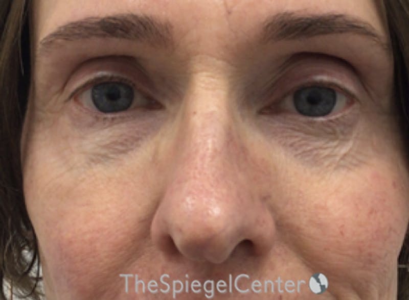 Rhinoplasty Before & After Gallery - Patient 379194 - Image 3