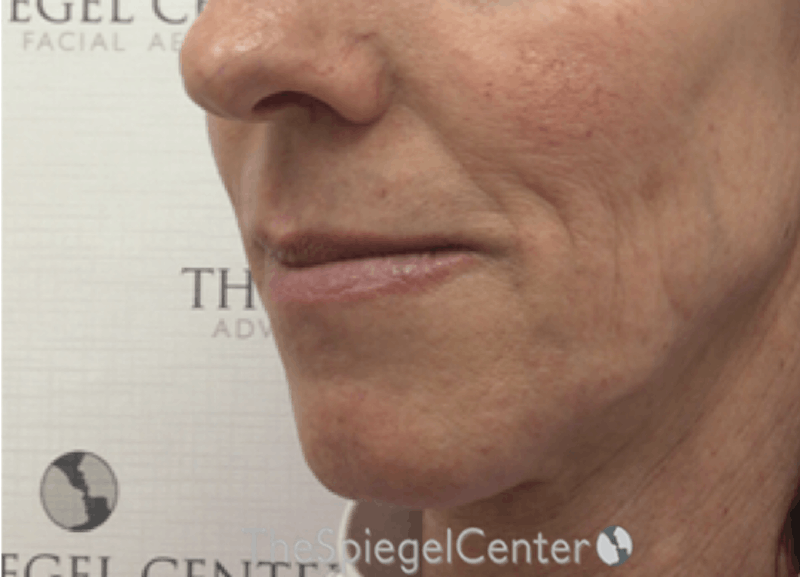 Lip Lift Before & After Gallery - Patient 183203 - Image 3